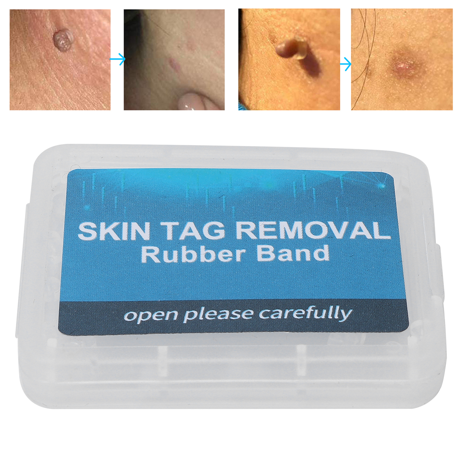30Pcs Painless Skin Tag Remova - огляд і ціна Skincare Ingredients Checker