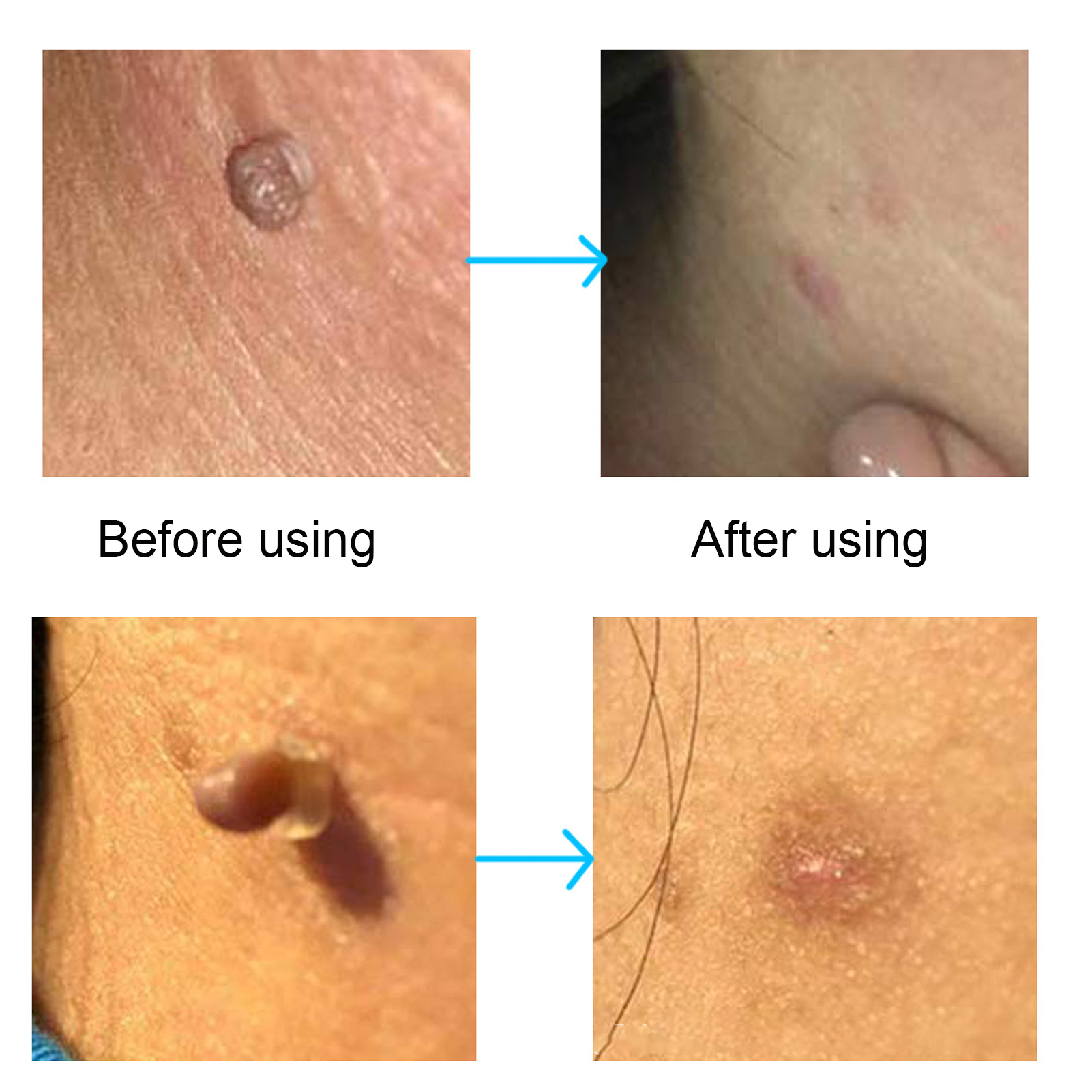 30Pcs Painless Skin Tag Remova - огляд і ціна Skincare Ingredients Checker