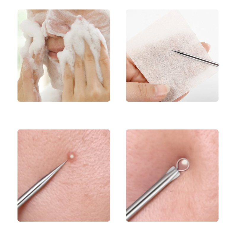 4pcs/set Acne Removal Needles  - огляд і ціна Skincare Ingredients Checker