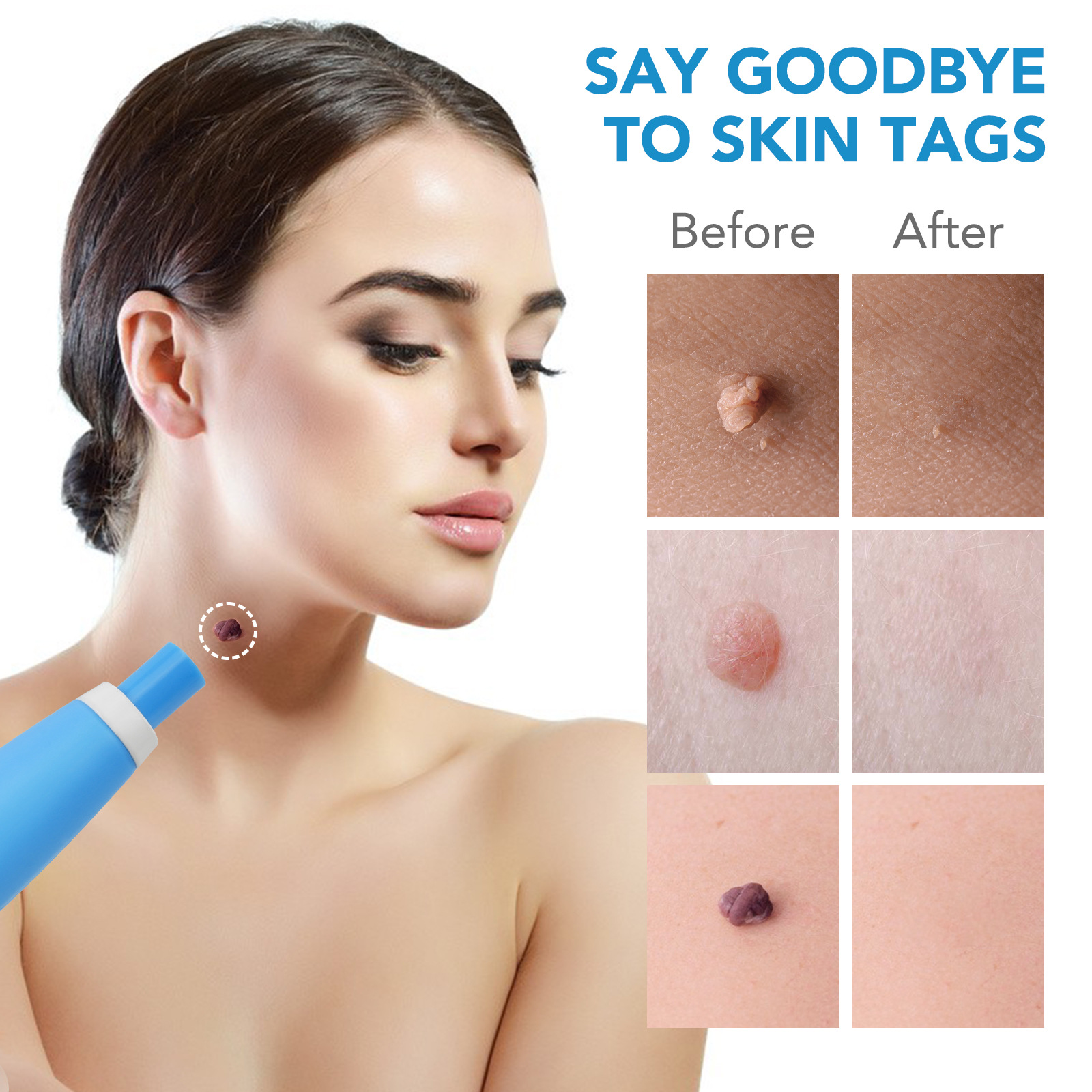 2 IN 1 Auto Skin Tag Remover K - огляд і ціна Skincare Ingredients Checker